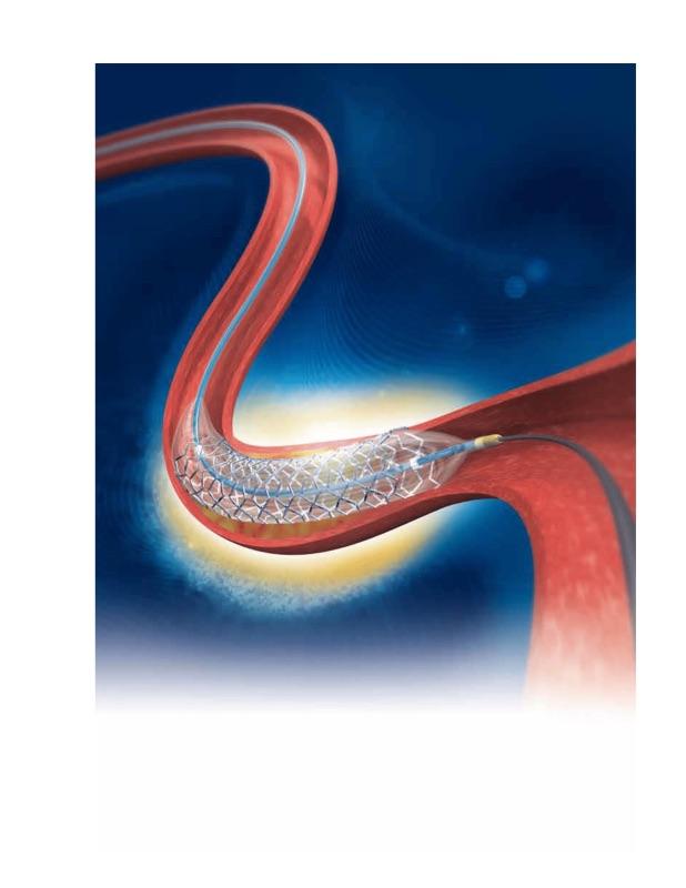 Стент-система коронарна з покриттям BioMatrix Alpha